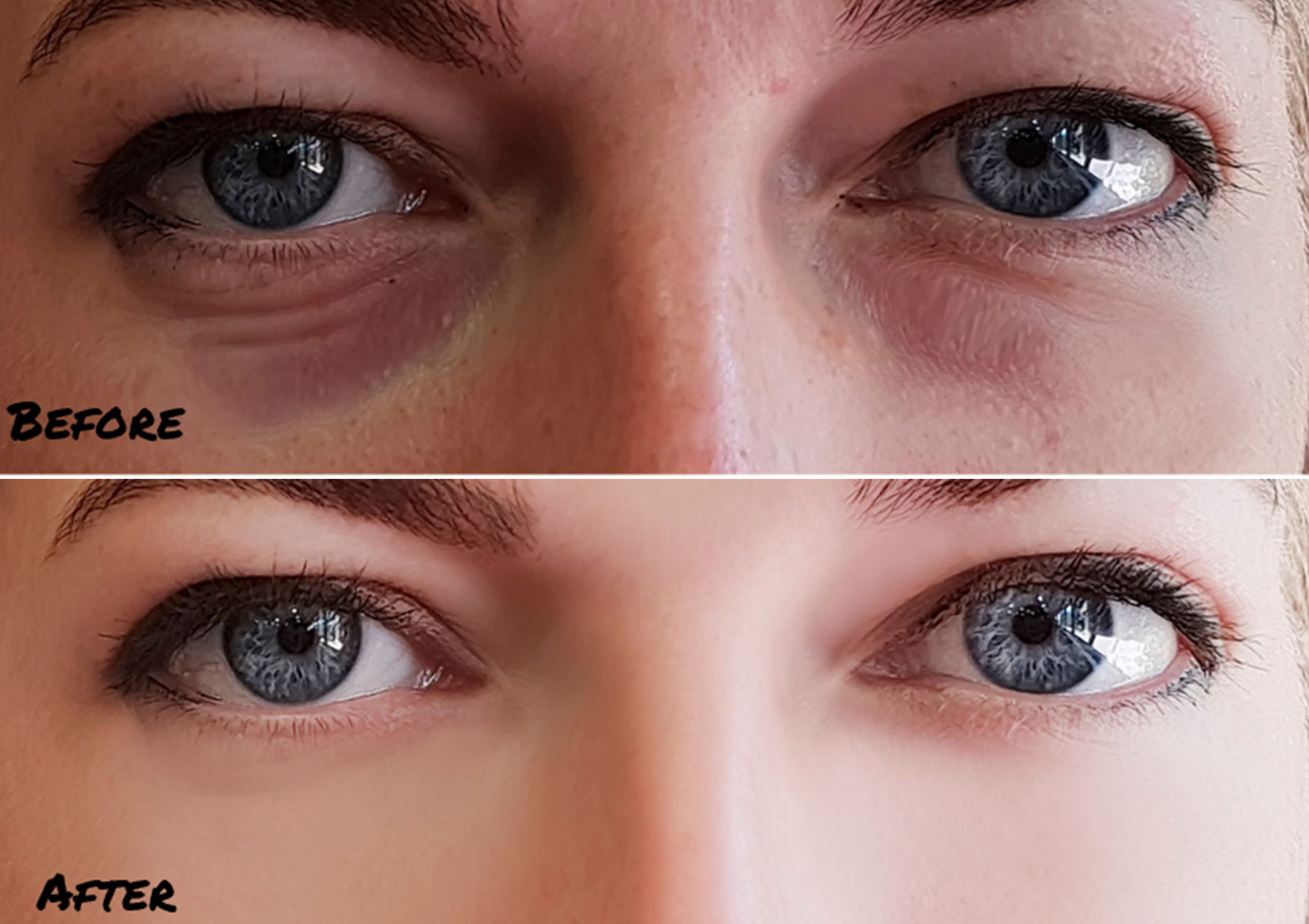 anti aging eye